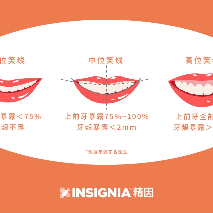 精因 · 微笑线